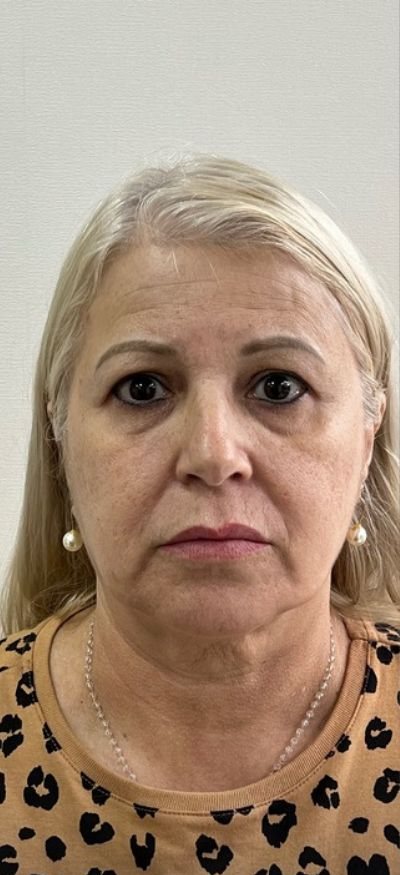 Antes: bioestimuladores de colágeno