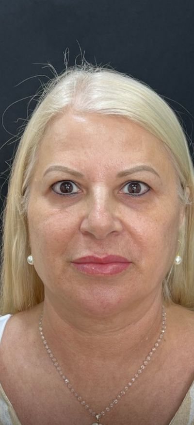 Depois: bioestimuladores de colágeno