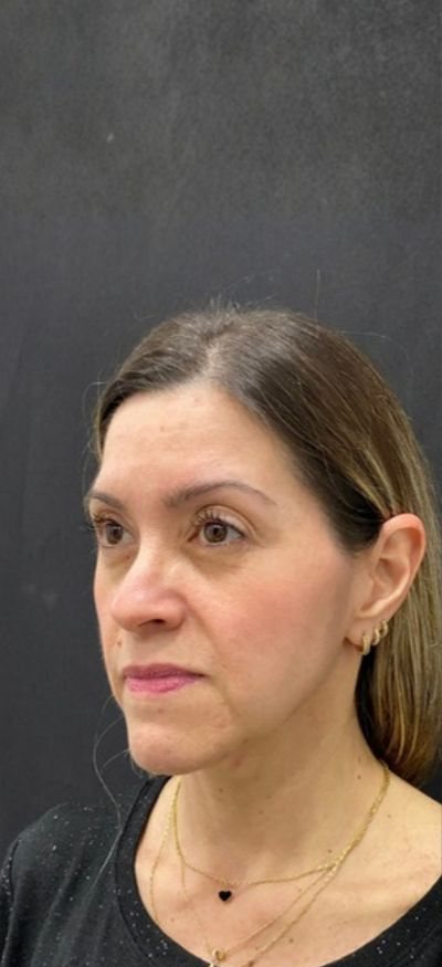 Antes: harmonização facial feminina
