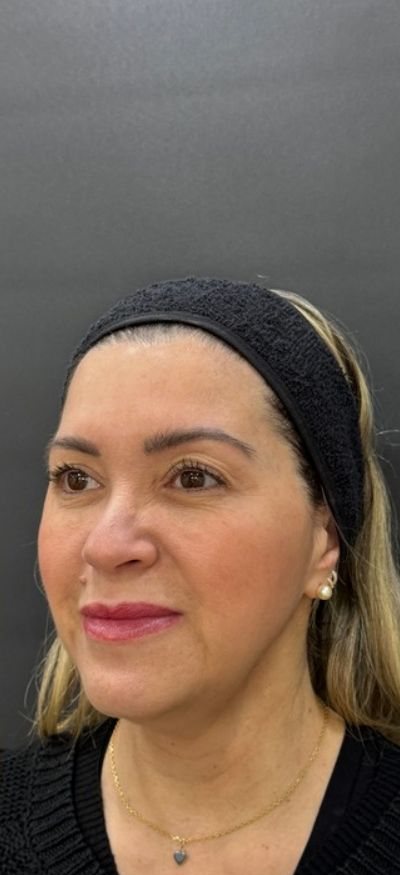 Depois: harmonização facial feminina