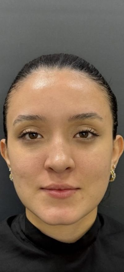Antes: preenchimento labial