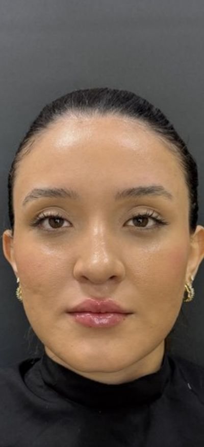Depois: preenchimento labial