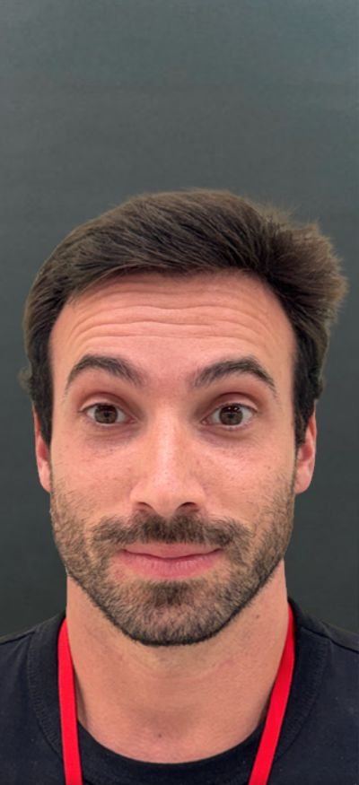 Antes: toxina botulínica