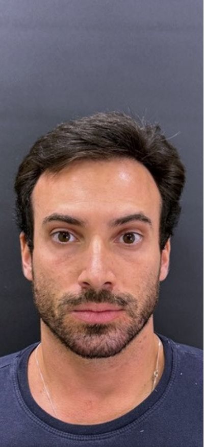 Depois: toxina botulínica